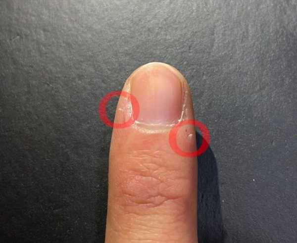 手起倒刺吃什么維生素,手指上長倒刺是因?yàn)槿狈S生素嗎圖2