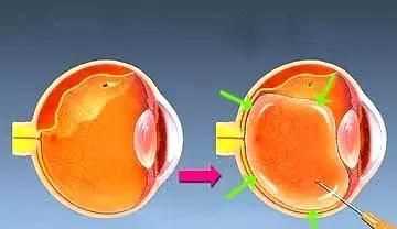 眼鏡可以帶上飛機(jī)嗎，五毫升的隱形眼鏡護(hù)理液可以隨身帶著上飛機(jī)嗎？圖7