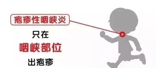 預(yù)防皰疹安全知識(shí)