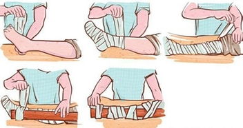 骨折急救小知識安全教育課件