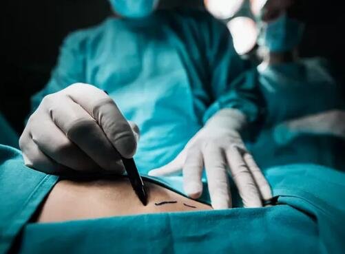 吸脂肪對身體有害嗎 吸脂肪對身體有害嗎