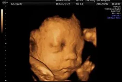 B超單有這個(gè)一般是女孩 B超單有這個(gè)一般是女孩