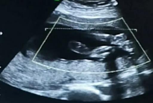 四維看男孩女孩訣竅 四維看男孩女孩訣竅