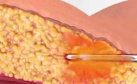 吸脂肪對身體有害嗎 吸脂肪對身體有害嗎