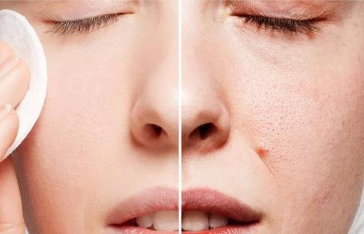 毛孔粗大怎么辦怎么收縮毛孔 毛孔粗大怎么辦怎么收縮毛孔