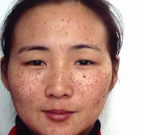 關于治療雀斑的方法有哪些