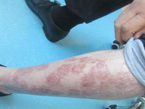 長春有治療銀屑病的醫(yī)院有哪些方法是什么