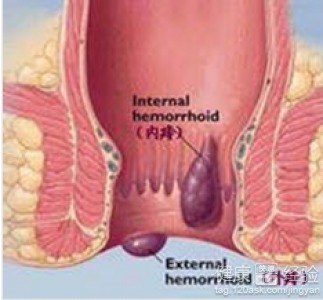 治療痔瘡病有什么方法有哪些