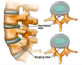 哪些方法可以治療腰間盤突出