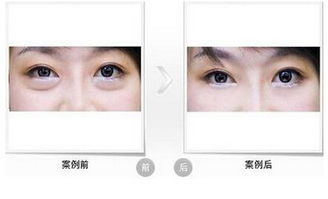 手術(shù)去除眼袋方法有哪些方法有哪些方法