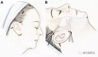 面部提升有哪些方法6