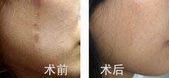 修復(fù)疤痕用什么方法有哪些