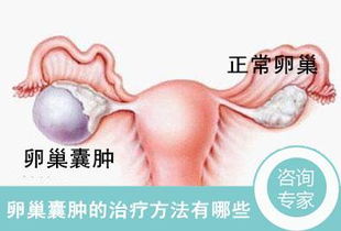 卵巢囊腫要怎樣治方法有哪些
