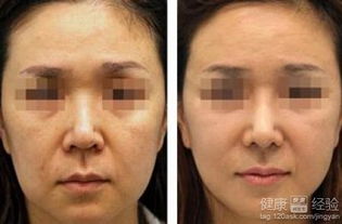 全面部提升有哪些手術(shù)方法