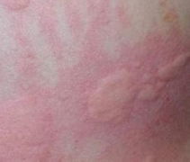 蕁麻疹有什么治療的方法有哪些