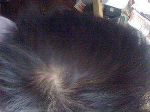 你知道有哪些好的治療脫發(fā)方法嗎