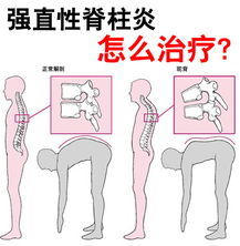 強直性脊柱炎運動方法有哪些方法有哪些