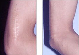 去疤痕醫(yī)院用哪些方法