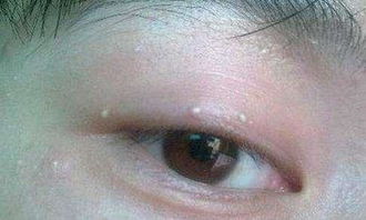 去掉脂肪粒的方法有哪些