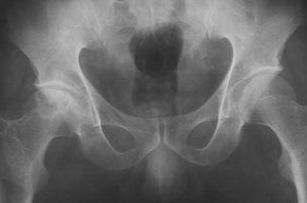 骶骨封閉治療方法打哪些部位