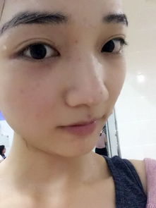 女生祛痘的方法有哪些