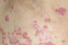 治療狼瘡的最新方法有哪些