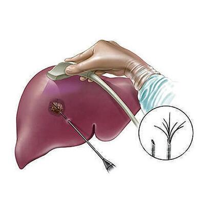 得了肝癌會有哪些癥狀怎么治療方法