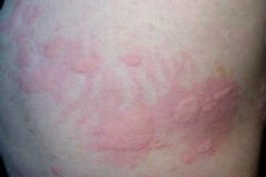 蕁麻疹治得好方法有哪些