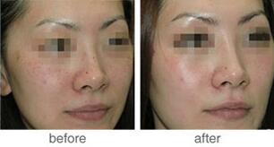 去除遺傳雀斑的方法有哪些