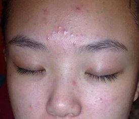 青春痘的食物療法有哪些方法