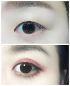 做了雙眼皮怎么恢復(fù)最快方法有哪些問題