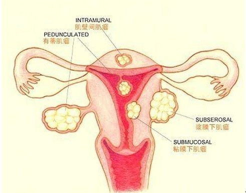 治子宮肌瘤常用哪些方法