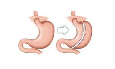 縮胃的有效方法有哪些