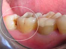 智齒都有哪些方法