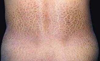 治療魚鱗病方法有哪些