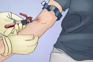 靜脈釆血的注意事項(xiàng)