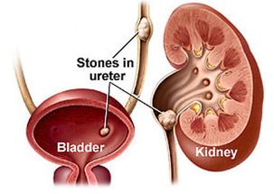 結(jié)石治療后需注意事項
