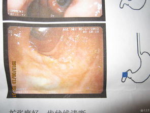 疣狀胃炎apc術(shù)后注意事項,疣狀胃炎術(shù)后飲食細則,疣狀胃炎術(shù)后一個月疼