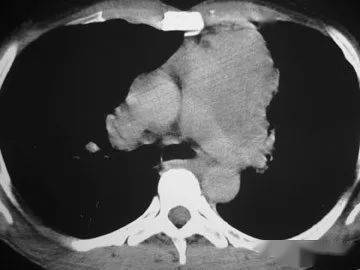 胸腺,化療,注意事項(xiàng)