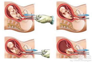 13周引產(chǎn)過程及注意事項