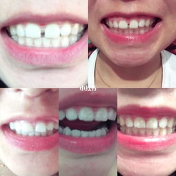 戴牙套期間注意事項