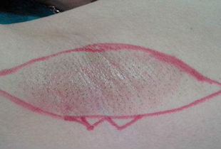 腳趾手術(shù)拆線后注意事項