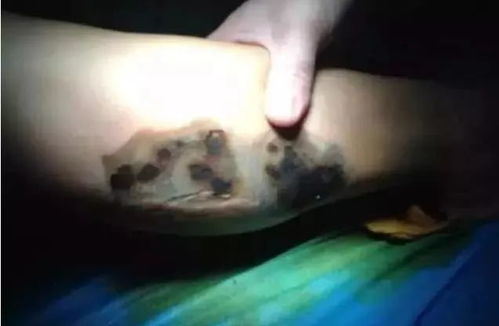 注意事項(xiàng),手術(shù),電刀