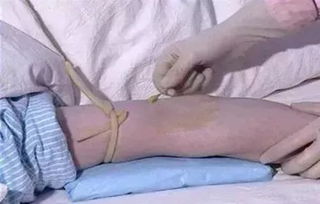 靜脈,注意事項(xiàng)