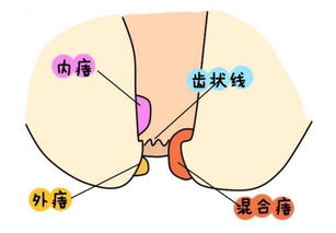 痔瘡術后十大注意事項,痔瘡手術后的注意事項,痔瘡術后注意事項及飲食禁忌