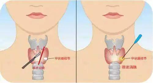 甲狀腺結(jié)節(jié)注意事項,甲狀腺結(jié)節(jié)的飲食方面應(yīng)注意事項,甲狀腺結(jié)節(jié)患者飲食注意事項