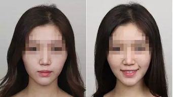 肌注,注射,事項(xiàng),蘋(píng)果