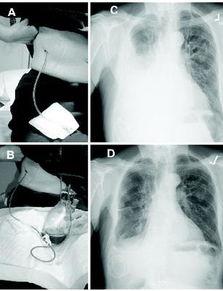胸腔,化療,注意事項(xiàng)