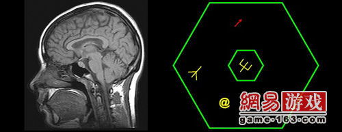 做腦部核磁共振注意事項