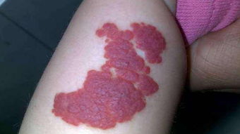 血管,激光,注意事項